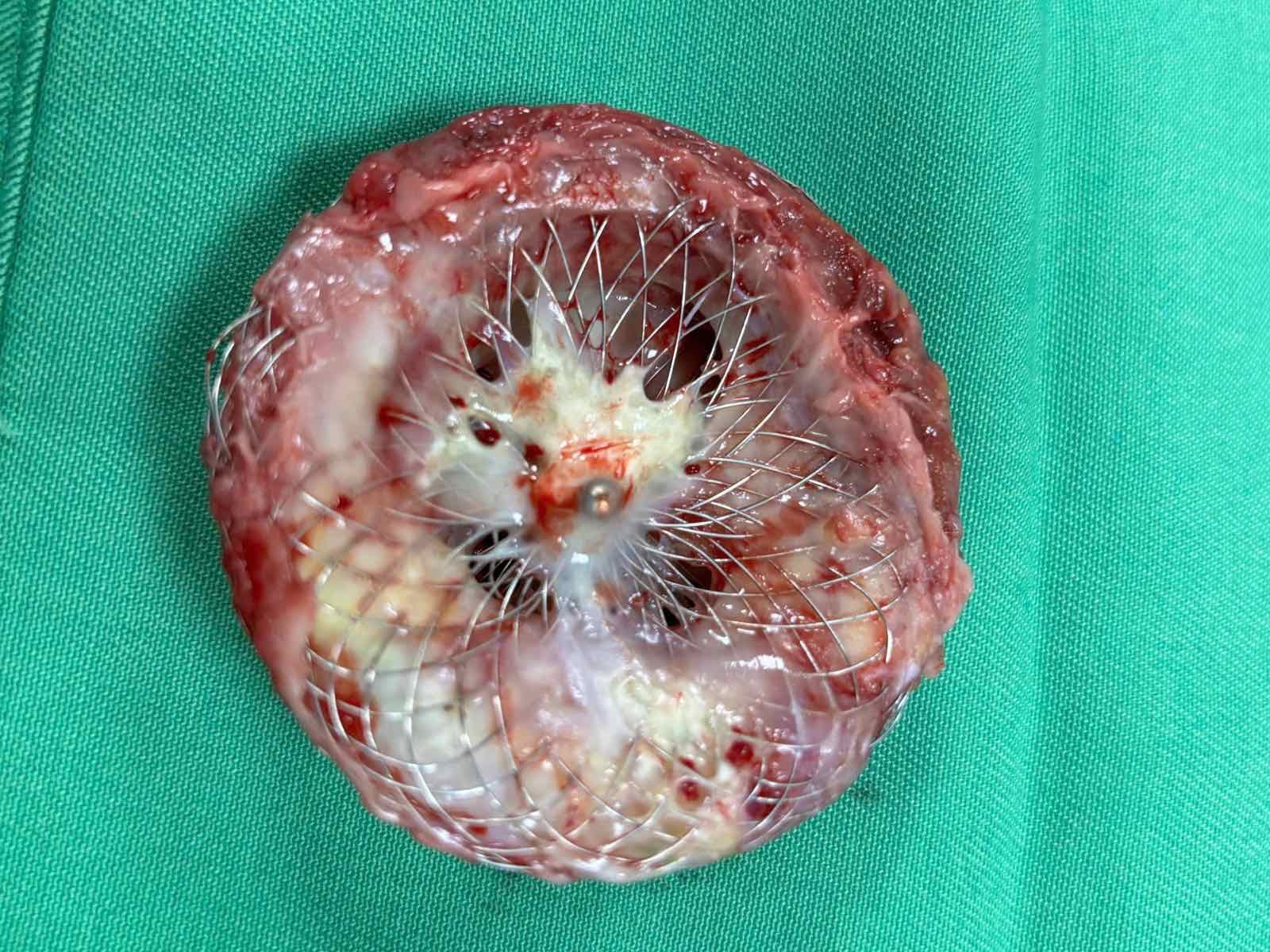 Bít Thông Liên Nhĩ Tồn Dư