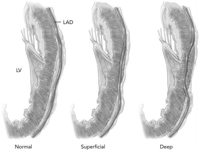 Cầu Cơ Động Mạch Vành (Myocardial Bridge) Là Gì?