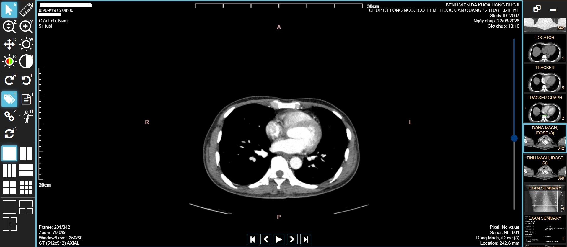 CT Scan