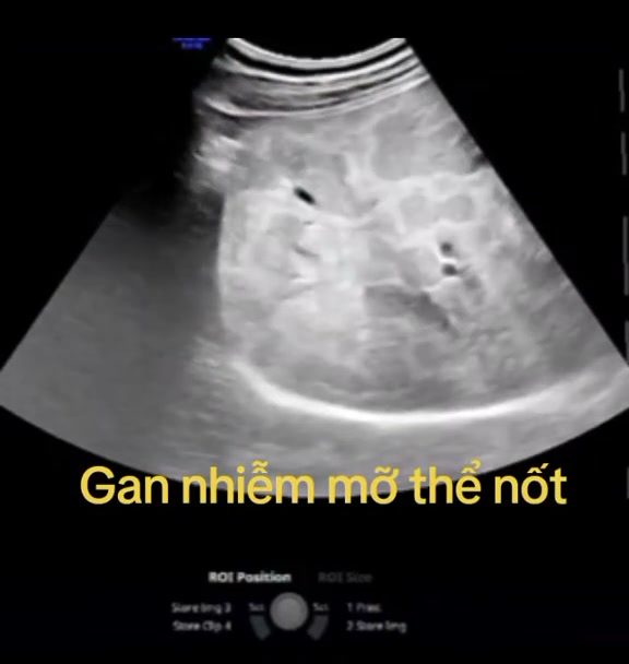 Vậy gan nhiễm mỡ là gì, chẩn đoán, tiên lượng và xử trí ra sao?