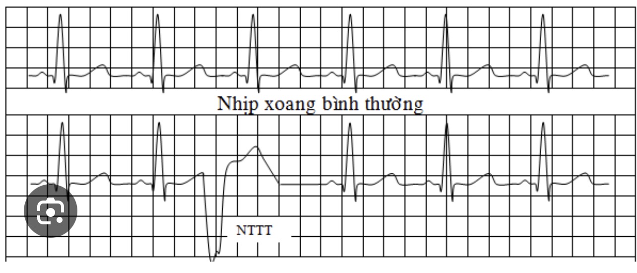 Ngoại Tâm Thu Thất (NTTT)